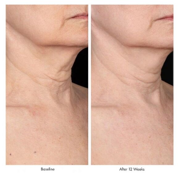 Obagi Elastiderm Neck And Decollete Concentrate 1 fl oz 30ml brand new in box - Picture 3 of 6